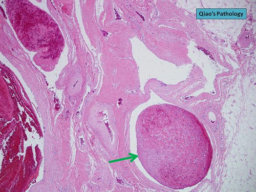 Qiao's Pathology: Subcutaneous Venous Hemangioma with Thrombosis | by Qiao's Pathology (Art and Science in Medicine)